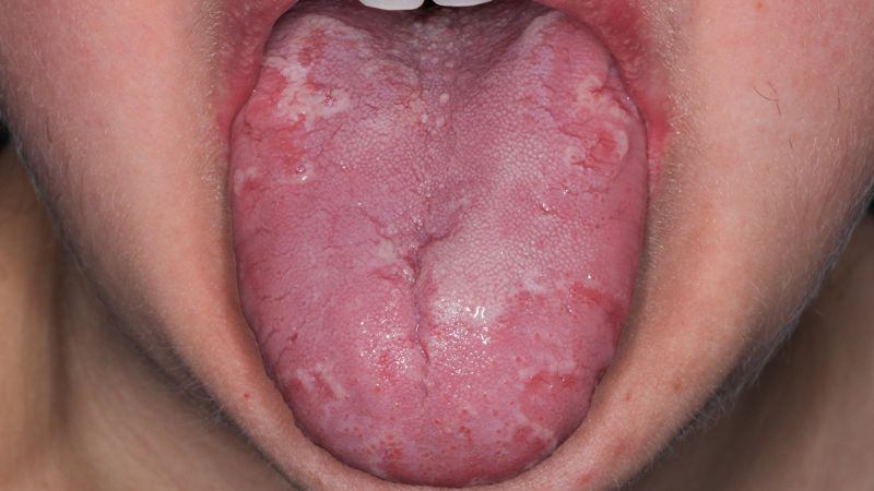 Xuất hiện các mảng đỏ, phẳng trên lưỡi là triệu chứng của bệnh Xuất hiện các mảng đỏ, phẳng trên lưỡi là triệu chứng của bệnh