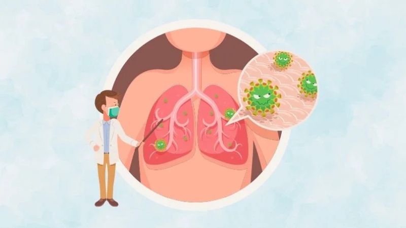 Viêm phổi do virus là tình trạng virus từ đường hô hấp trên xâm nhập vào phế nang