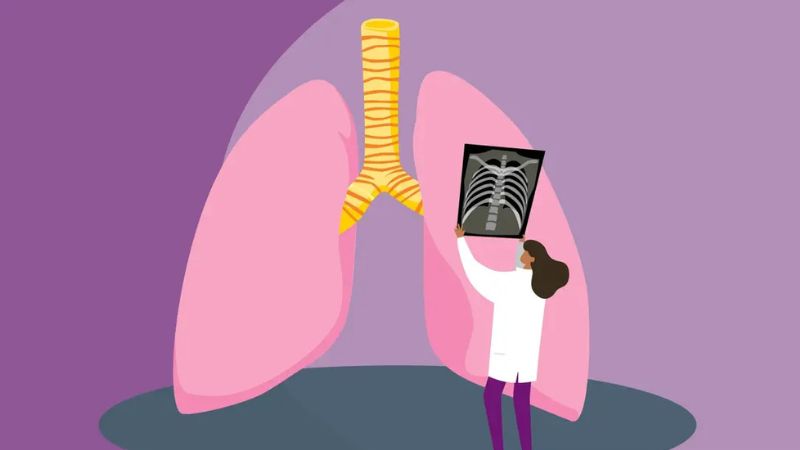 Chụp X-quang ngực là biện pháp giúp bác sĩ chẩn đoán vị trí viêm phổi do virus
