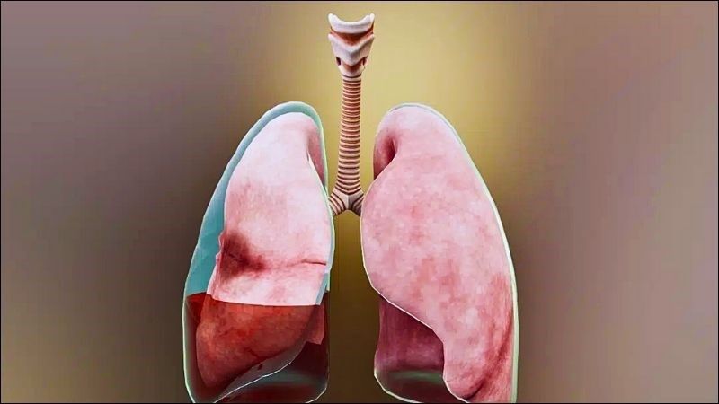 Tràn dịch màng phổi là một trong những biến chứng của bệnh