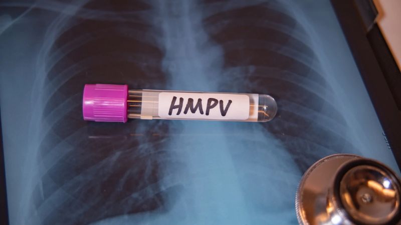Chụp X-quang ngực thẳng giúp chẩn đoán các tổn thương phổi nguy hiểm do nhiễm HMPV Chụp X-quang ngực thẳng giúp chẩn đoán các tổn thương phổi nguy hiểm do nhiễm HMPV