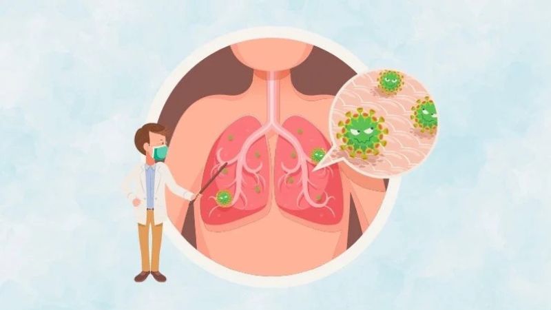 xét nghiệm lao phổi là để chẩn đoán Lao là đúng