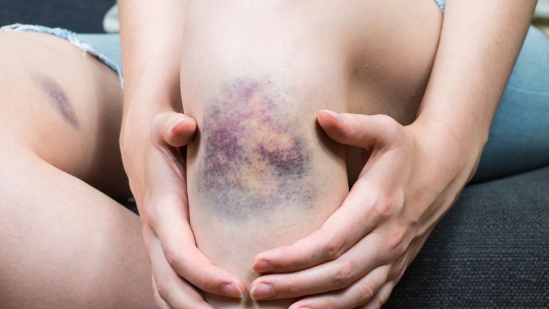 Xét nghiệm máu có thể giúp chẩn đoán nguyên nhân gây bầm tím