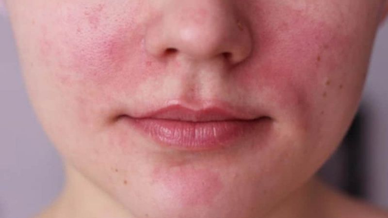 Đỏ da là tác dụng phụ thường gặp khi xông hơi mặt