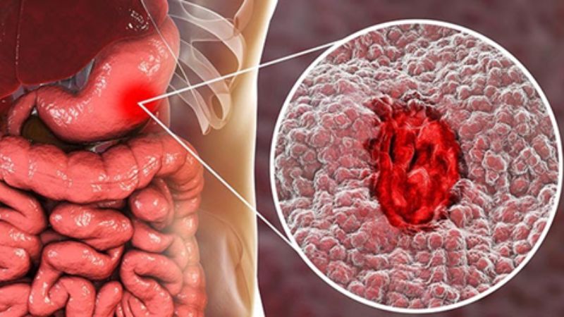 Loét dạ dày tá tràng là nguyên nhân gây xuất huyết tiêu hóa trên