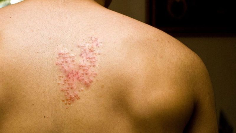 Zona thần kinh được gây ra bởi virus Varicella zoster (VZV)
