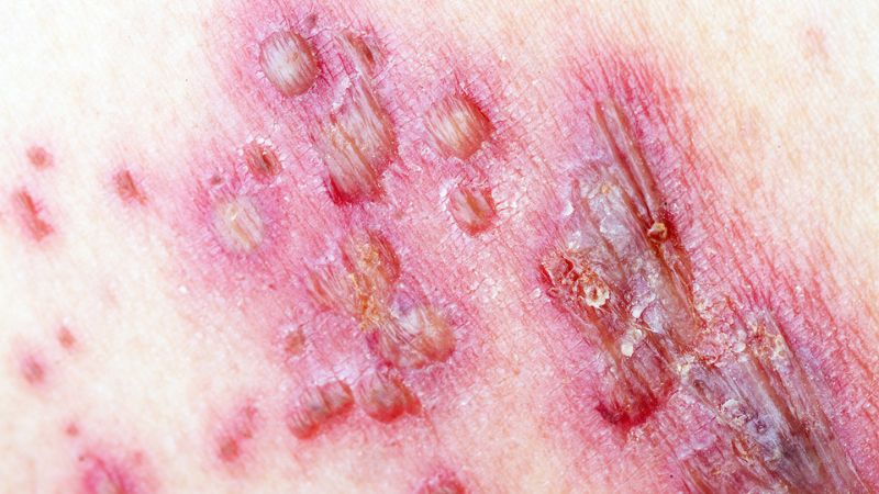 Virus gây zona thần kinh có thể lây nhiễm trong 7 - 10 ngày khi mụn nước vỡ ra