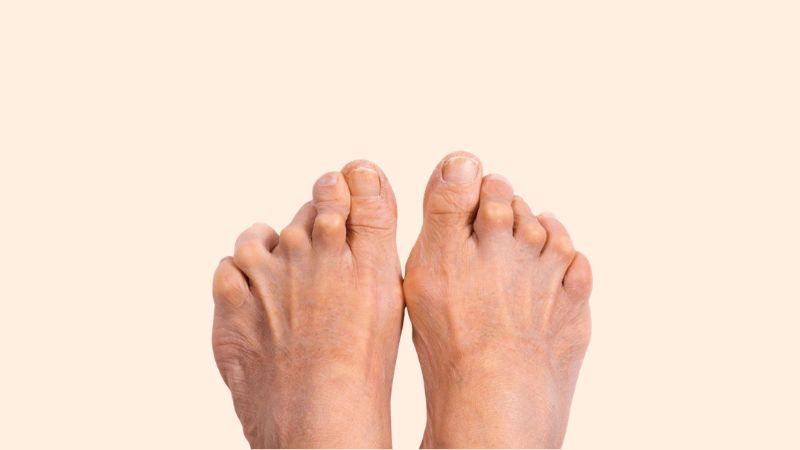 Đa xơ cứng là bệnh tự miễn có khả năng gây tê chân Đa xơ cứng là bệnh tự miễn có khả năng gây tê chân