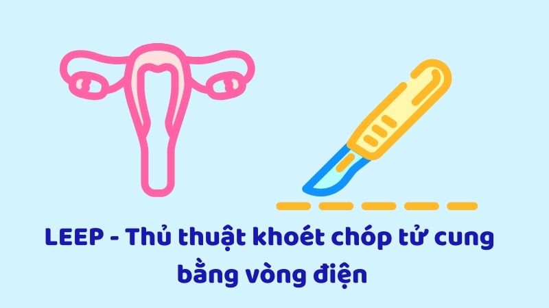 LEEP là thủ thuật loại bỏ một phần tử cung hình nón có tổn thương hoặc bị biến đổi LEEP là thủ thuật loại bỏ một phần tử cung hình nón có tổn thương hoặc bị biến đổi