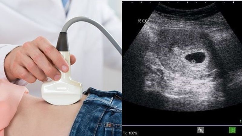 Siêu âm là một trong những xét nghiệm quan trọng trong khám thai định kỳ