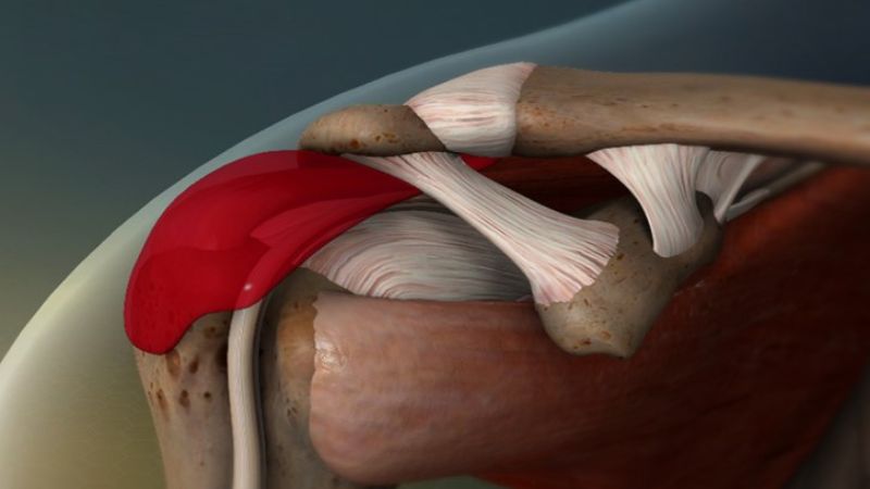 Viêm gân vùng vai có thể dẫn tới khó khăn khi vận động khớp vai Viêm gân vùng vai có thể dẫn tới khó khăn khi vận động khớp vai