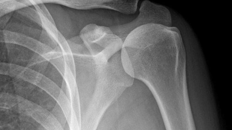 X-quang dùng để xác định có chấn thương khớp vai không X-quang dùng để xác định có chấn thương khớp vai không