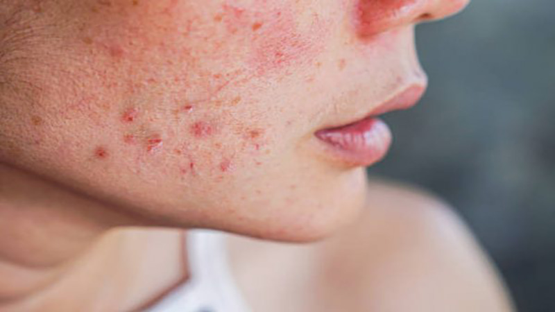 Đau và sưng nướu răng, có thể chảy máu thường xảy ra ở một số phụ nữ khi mang thai