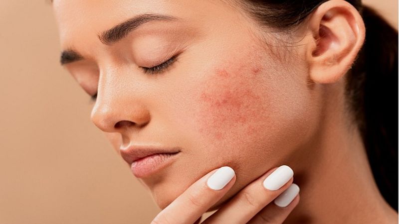 Nghệ tây giúp hỗ trợ lành vết thương và giảm hình thành sẹo