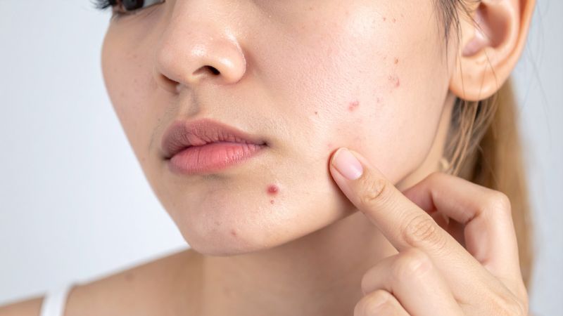 Xông mặt đúng cách giúp hỗ trợ tình trạng mụn Xông mặt đúng cách giúp hỗ trợ tình trạng mụn