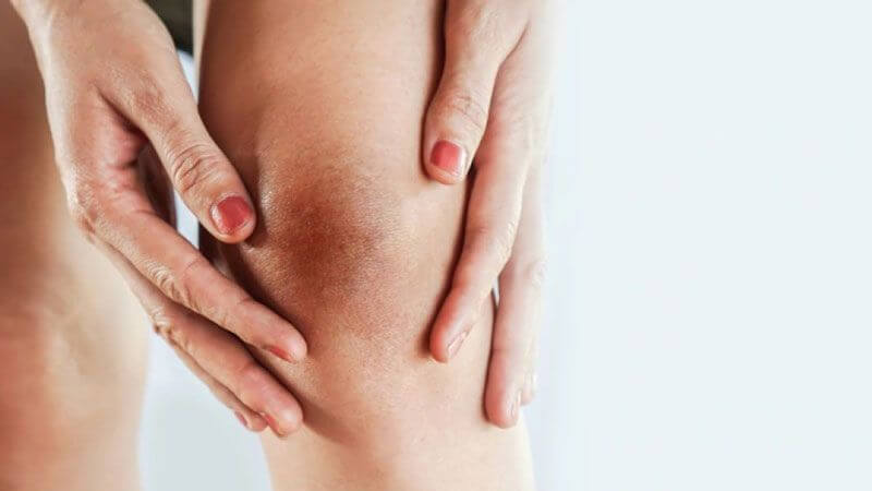Da đầu gối có thể bị thâm sạm tối màu do tiếp xúc với ánh nắng mặt trời hoặc do ma sát với quần áo