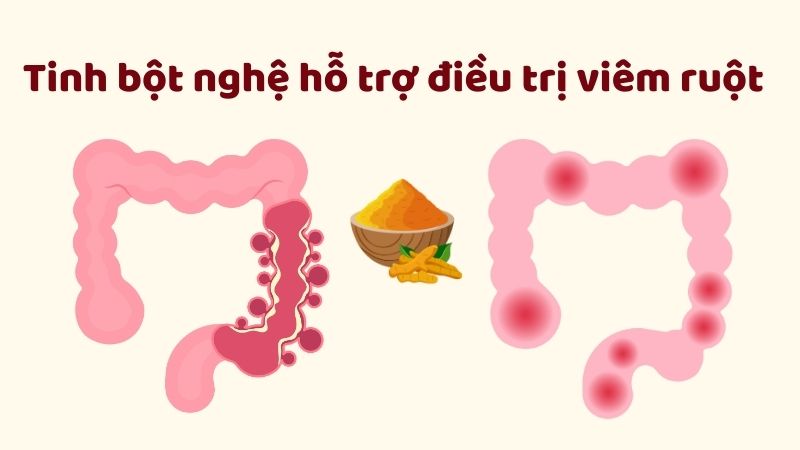 Tinh bột nghệ là một liệu pháp hỗ trợ điều trị viêm ruột hiệu quả, đặc biệt khi kết hợp với thuốc mesalazine