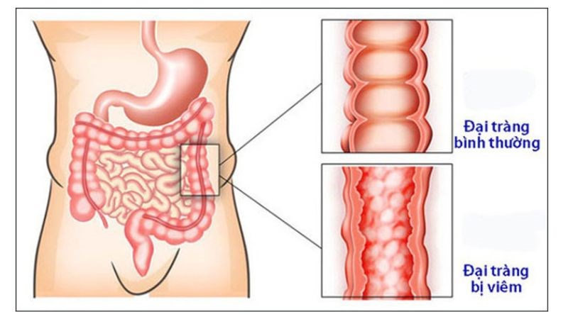 Viêm đại tràng gây ra các tổn thương viêm và loét vùng đại - trực tràng