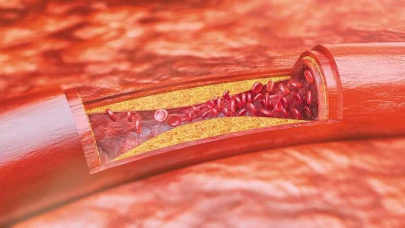 Vitamin B3 có khả năng làm giảm cholesterol xấu và làm tăng cholesterol tốt, hỗ trợ ngăn ngừa xơ vữa động mạch Vitamin B3 có khả năng làm giảm cholesterol xấu và làm tăng cholesterol tốt, hỗ trợ ngăn ngừa xơ vữa động mạch