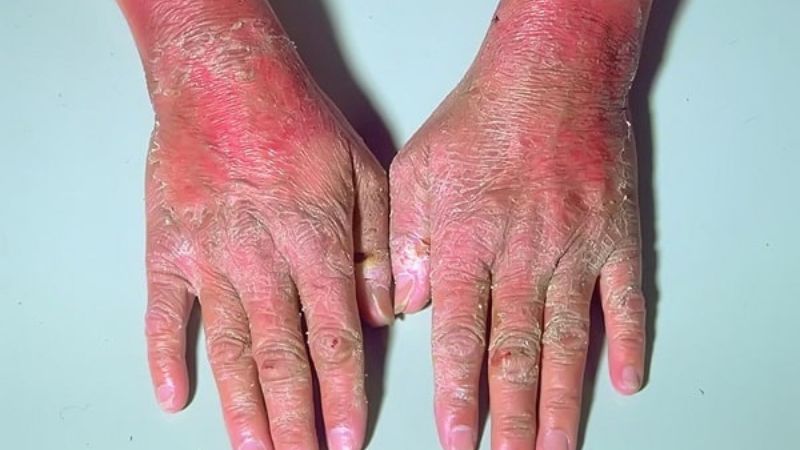 Vitamin B3 đóng vai trò quan trọng trong việc điều trị bệnh Pellagra Vitamin B3 đóng vai trò quan trọng trong việc điều trị bệnh Pellagra