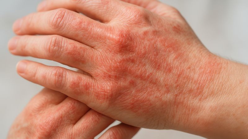 Một số người có thể gặp dị ứng, phát ban trên da khi dùng Glucosamin Một số người có thể gặp dị ứng, phát ban trên da khi dùng Glucosamin