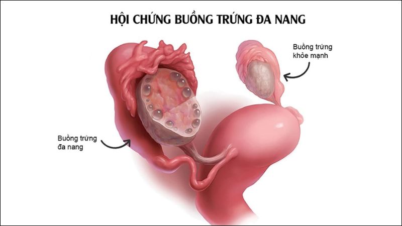 Hội chứng buồng trứng đa nang là một rối loạn nội tiết ở phụ nữ
