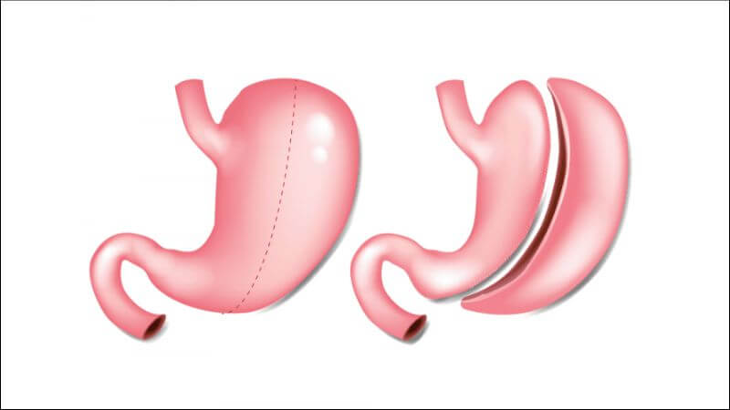 Phẫu thuật cắt bỏ dạ dày làm giảm hấp thụ vitamin B12