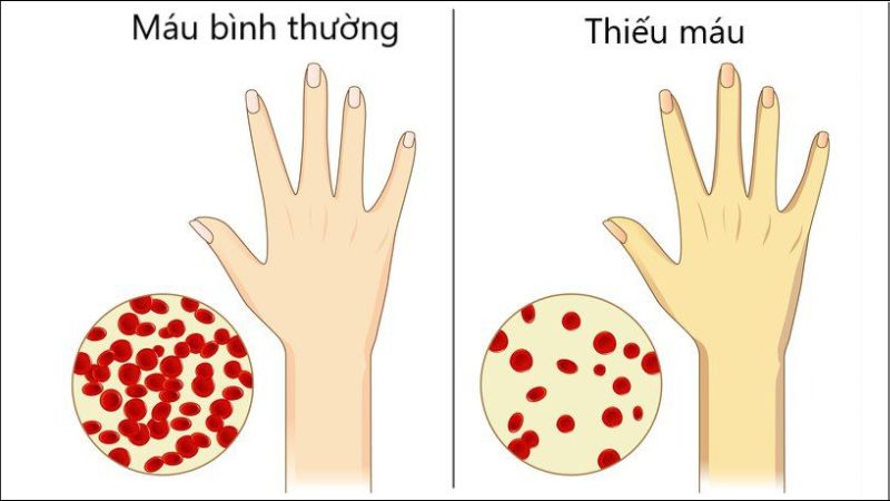 Thiếu sắt là nguyên nhân phổ biến nhất gây thiếu máu