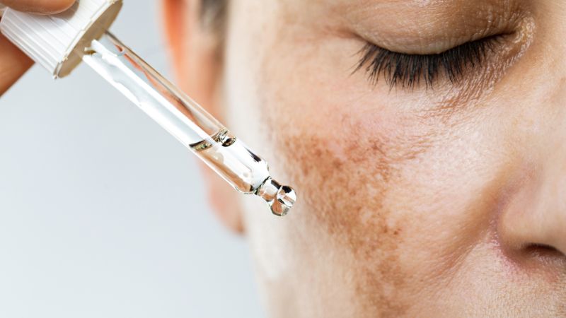 Sử dụng Retinol tại chỗ giúp cải thiện tình trạng tăng sắc tố sau vài tháng sử dụng