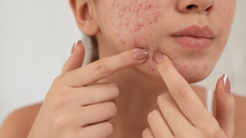 Retinol hỗ trợ giảm mụn trứng cá và sẹo rỗ