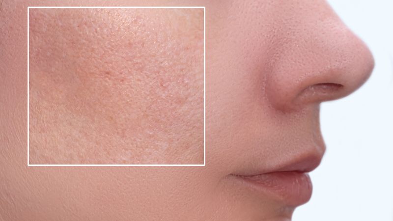 Retinol hỗ trợ giảm tình trạng lỗ chân lông bị bít tắc