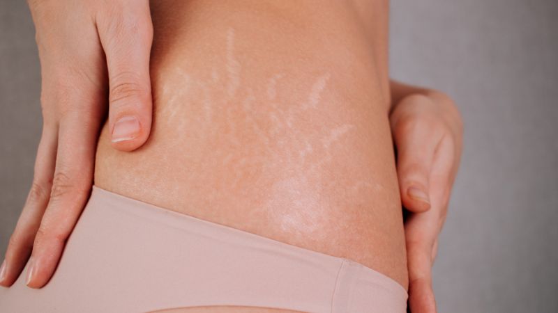 Retinol có thể hỗ trợ làm mờ vết rạn da