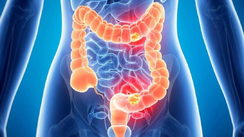 Histidine có khả năng hỗ trợ điều trị các bệnh viêm ruột