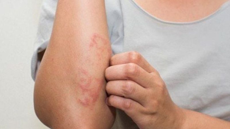 Bổ sung histidine giúp củng cố hàng rào da và cải thiện triệu chứng dị ứng