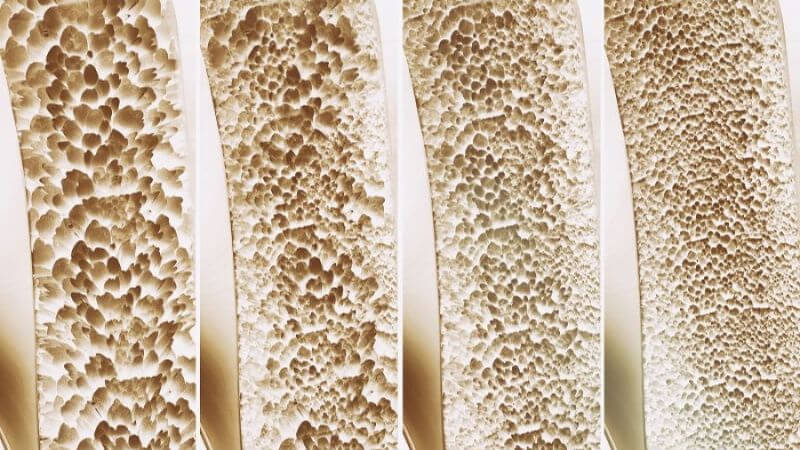 Mangan phối hợp với các vitamin và khoáng chất khác giúp cải thiện mật độ xương