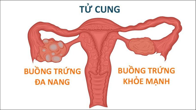 Bổ sung crom picolinate giúp giảm BMI, insulin lúc đói và testosterone tự do ở bệnh nhân PCOS