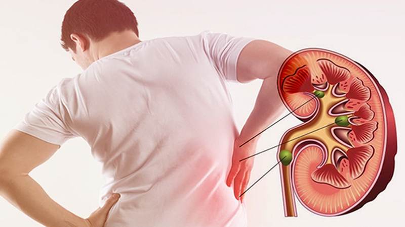 Đau ở bên hông và lưng là một dấu hiệu khi có sỏi canxi oxalat trong nước tiểu