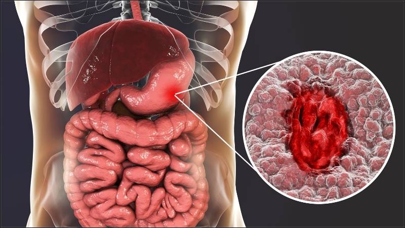 Quả tầm xu&acirc;n c&oacute; t&aacute;c dụng hỗ trợ điều trị lo&eacute;t dạ d&agrave;y t&aacute; tr&agrave;ng