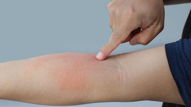 Bản làm căn có trong bài thuốc tiêu viêm, trị bệnh ngoài da