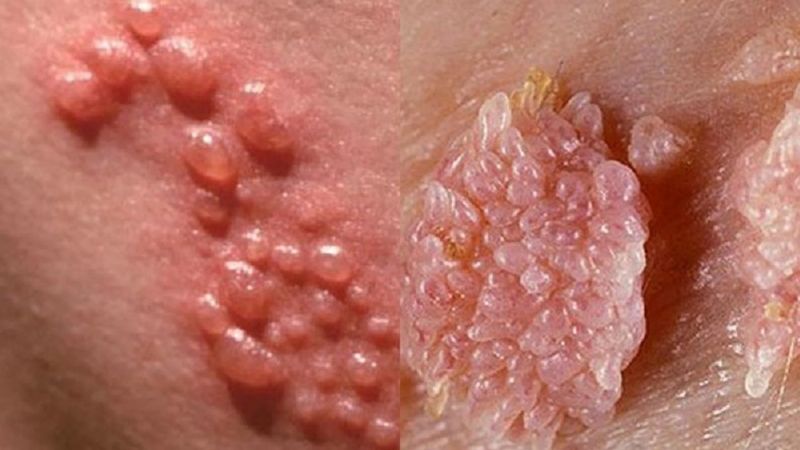 Bản lam căn có mặt trong bài thuốc trị sùi mào gà