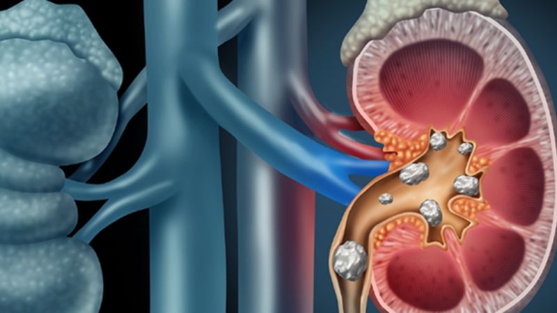 Chế độ ăn uống giàu kali là yếu tố quan trọng giúp ngăn ngừa sỏi thận