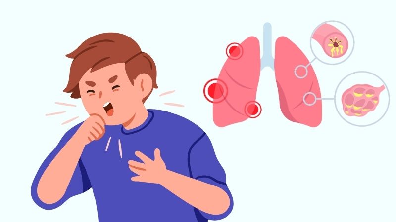 Hoài sơn hỗ trợ điều trị viêm phế quản mãn tính