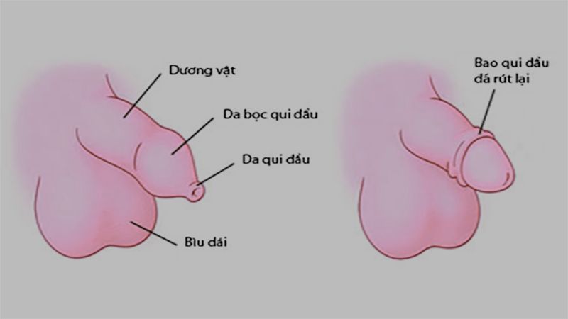 Hẹp bao quy đầu ở trẻ