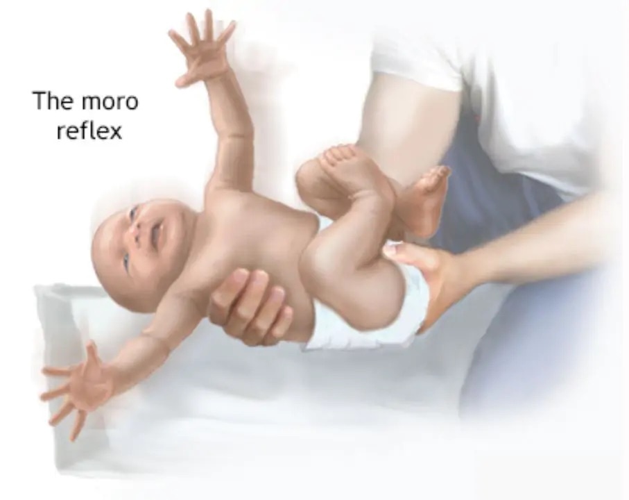 Phản xạ Moro thường xảy ra khi bé bị giật mình