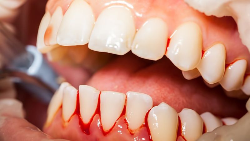 Bệnh nhân sốt xuất huyết có chảy máu nướu nên đến bệnh viện sớm