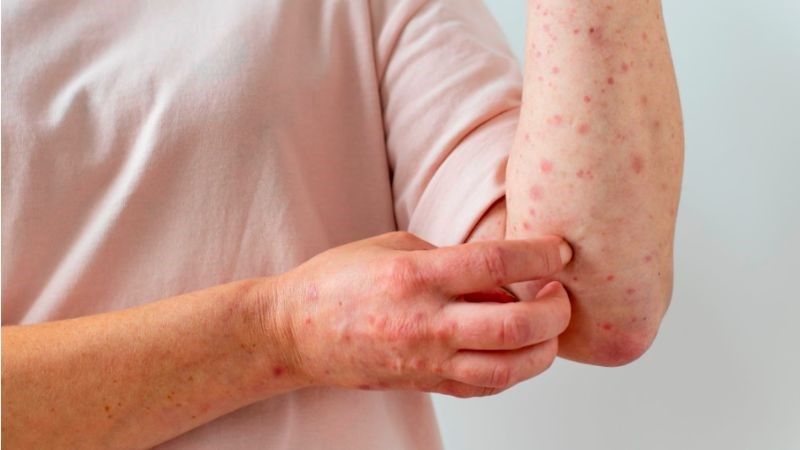 Người bệnh có thể phát ban và kèm ngứa ở giai đoạn hồi phục