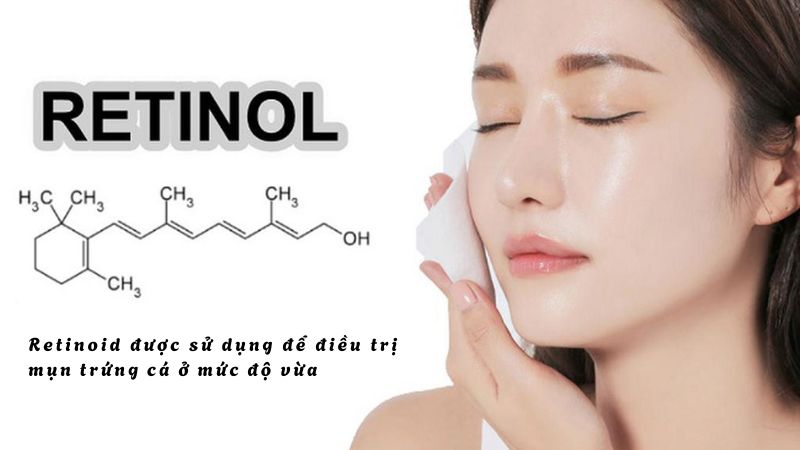 Retinoid được sử dụng để điều trị mụn trứng cá ở mức độ vừa