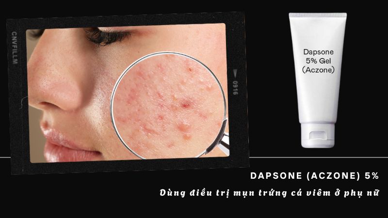 Dapsone 5% được dùng để điều trị mụn trứng cá viêm ở phụ nữ