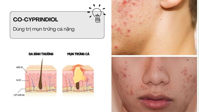 Co-cyprindiol được dùng trong điều trị mụn trứng cá ở mức độ nặng