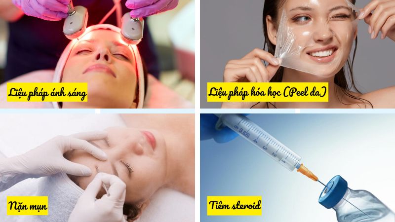 Một số liệu pháp trị mụn có thể kết hợp với dùng thuốc để tăng hiệu quả trị liệu
